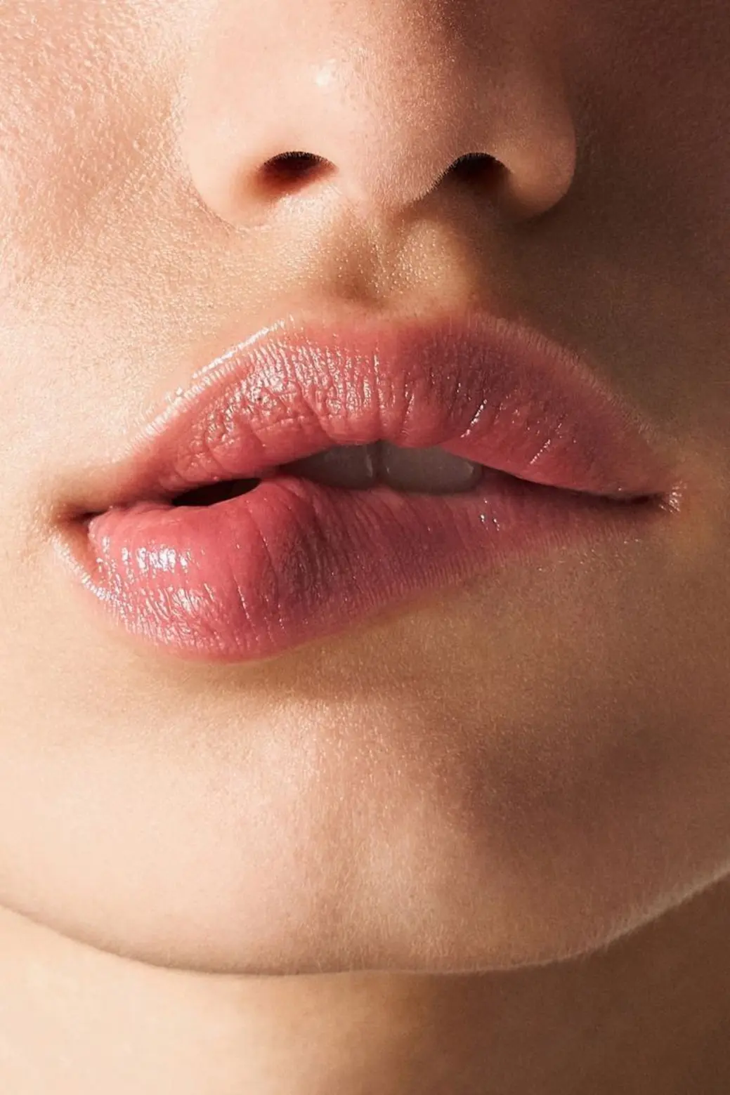 The "Ideal" Lips Lip Lift