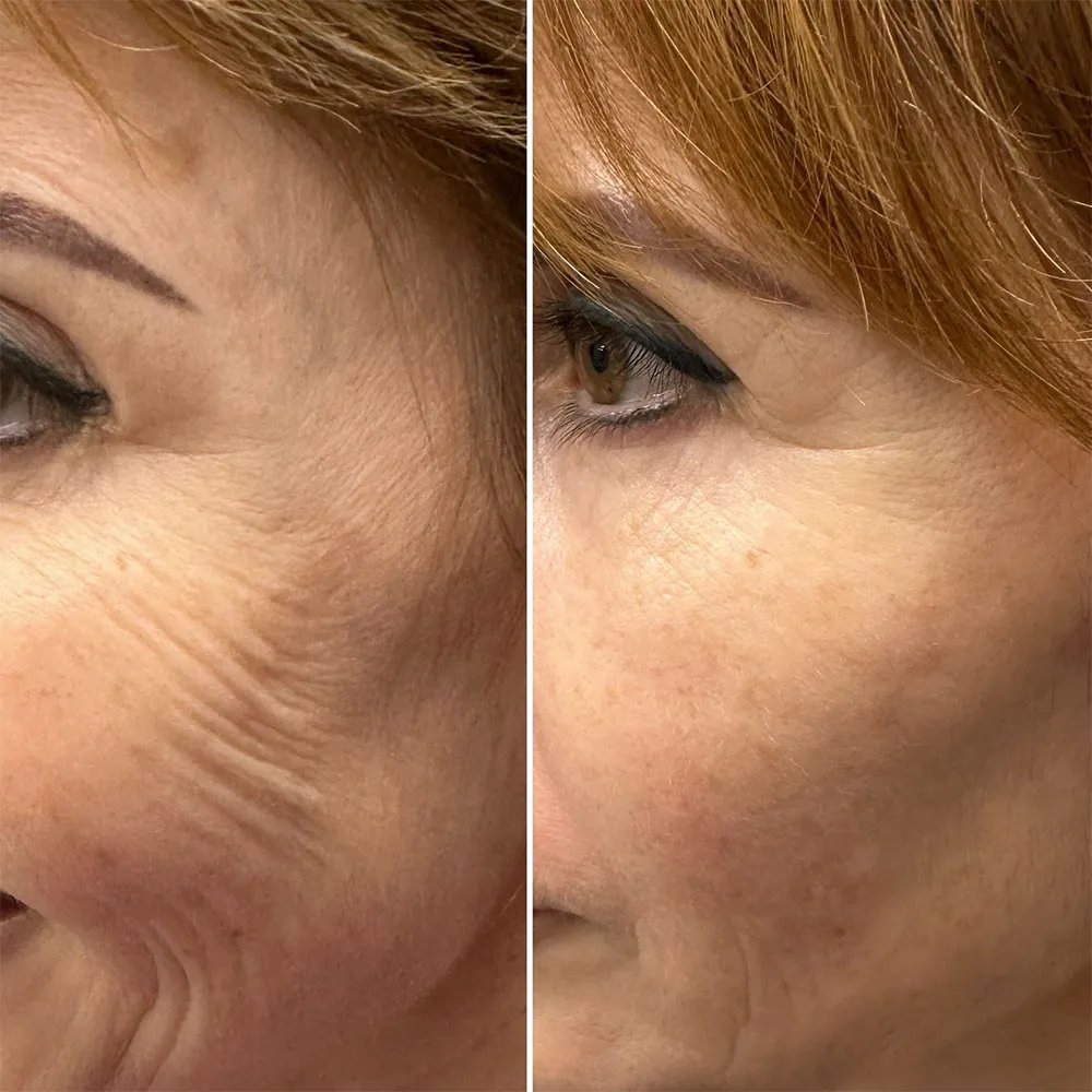 Before and after exosome treatment Before and after exosome treatment