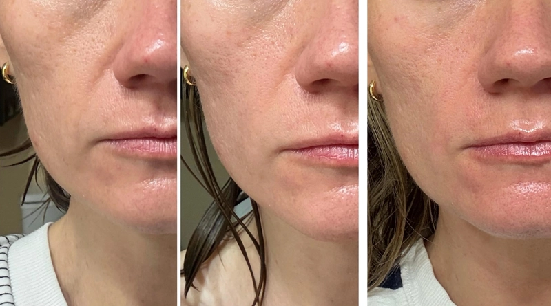 The result after using Volufiline serum Why Did Volufiline Suddenly Become Huge in 2026? 4