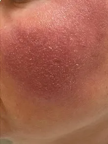 Nahaufnahme einer geröteten und gereizten Hautpartie im Gesicht mit sichtbarer Schuppung.