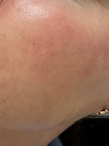 Nahaufnahme einer Wange mit leicht geröteter Haut und unauffälliger Textur.