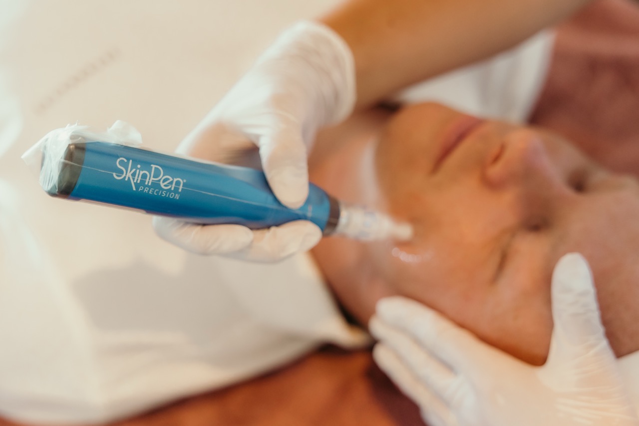 microneedling