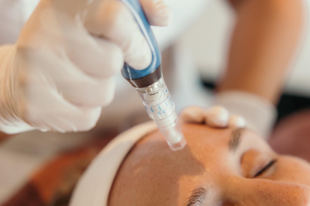 Acne litteken behandeling Ons Huidhof