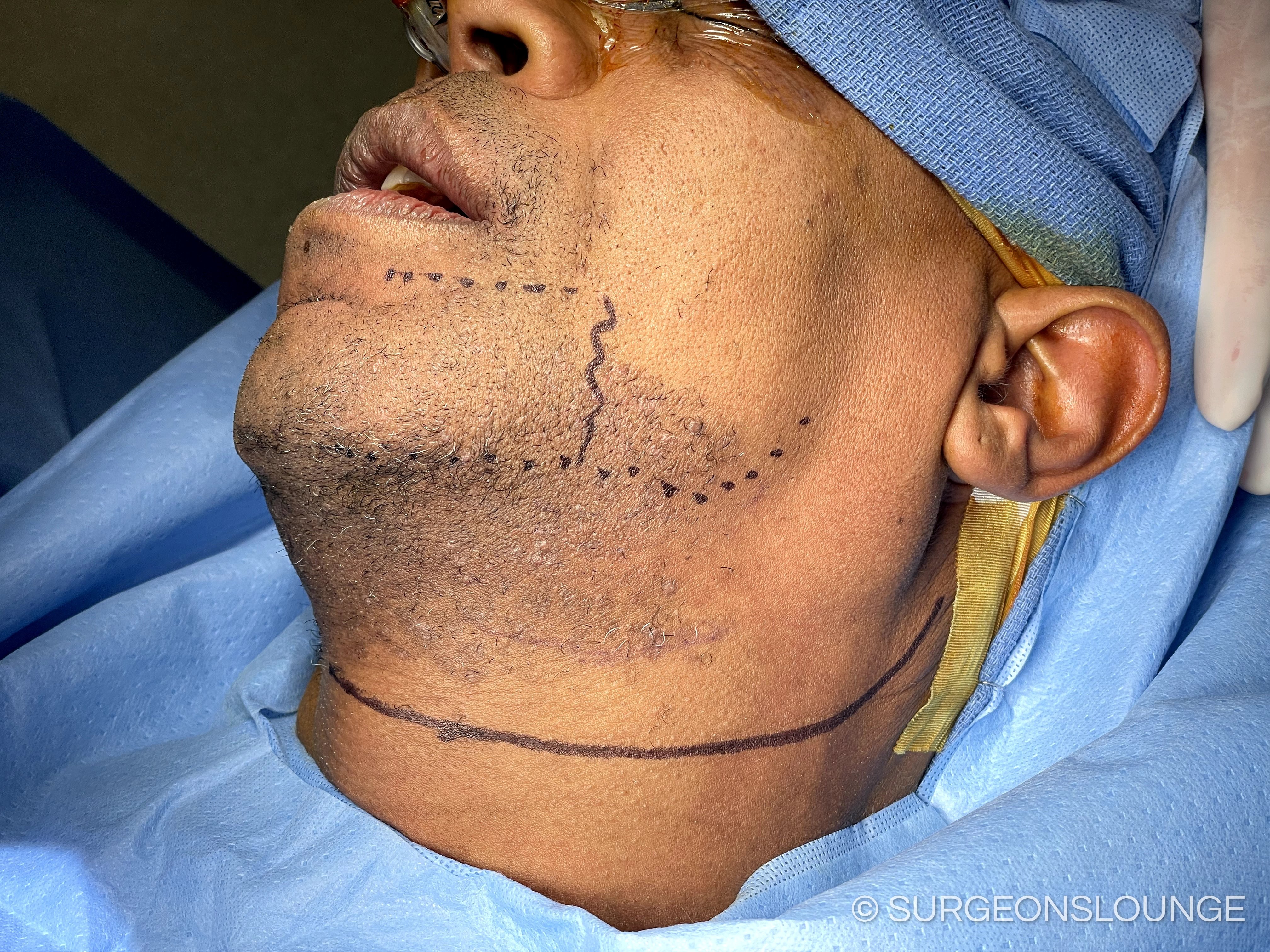 A person with lines on his neckDescription automatically generated