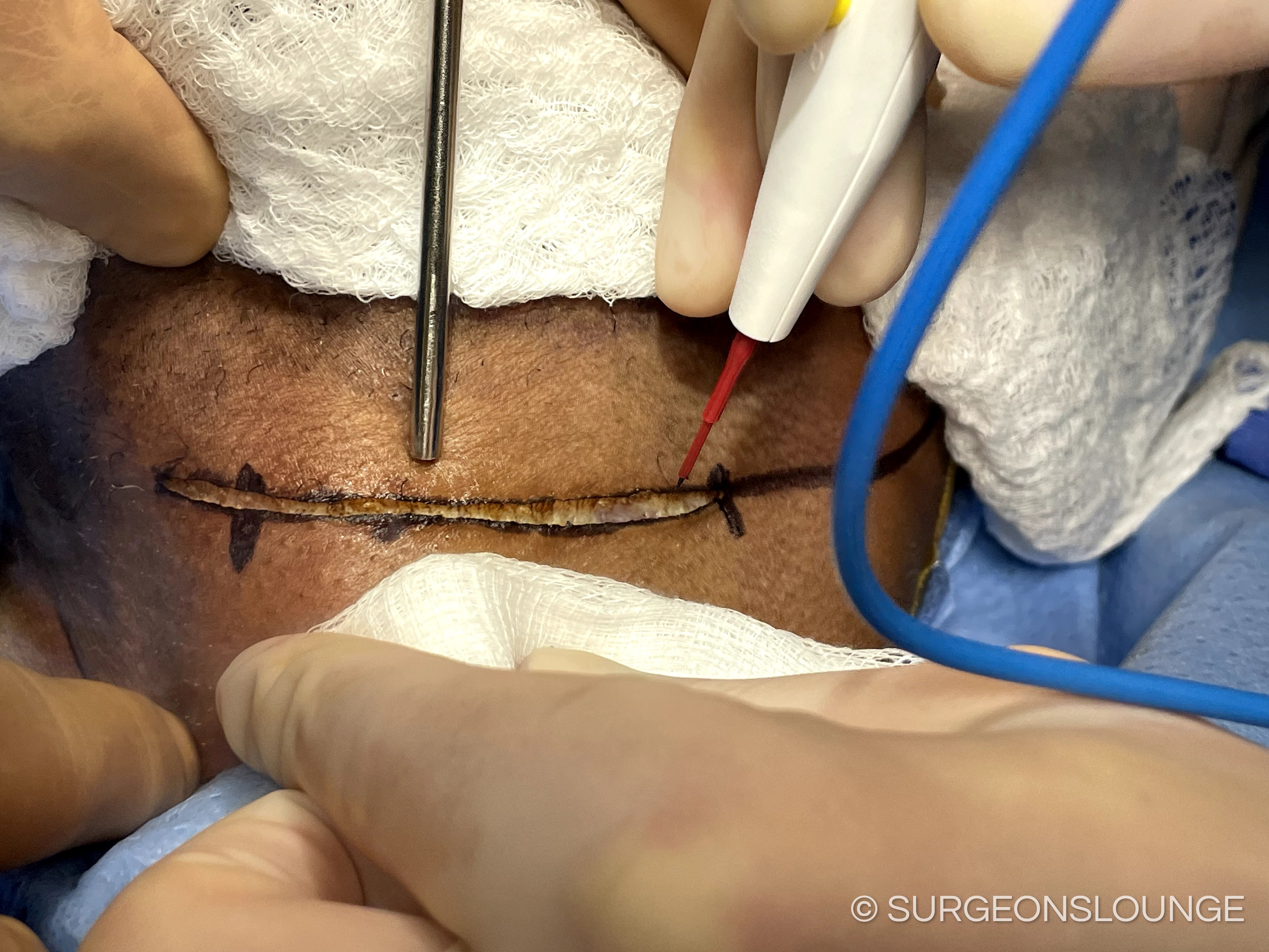 A person with a scar on their backDescription automatically generated