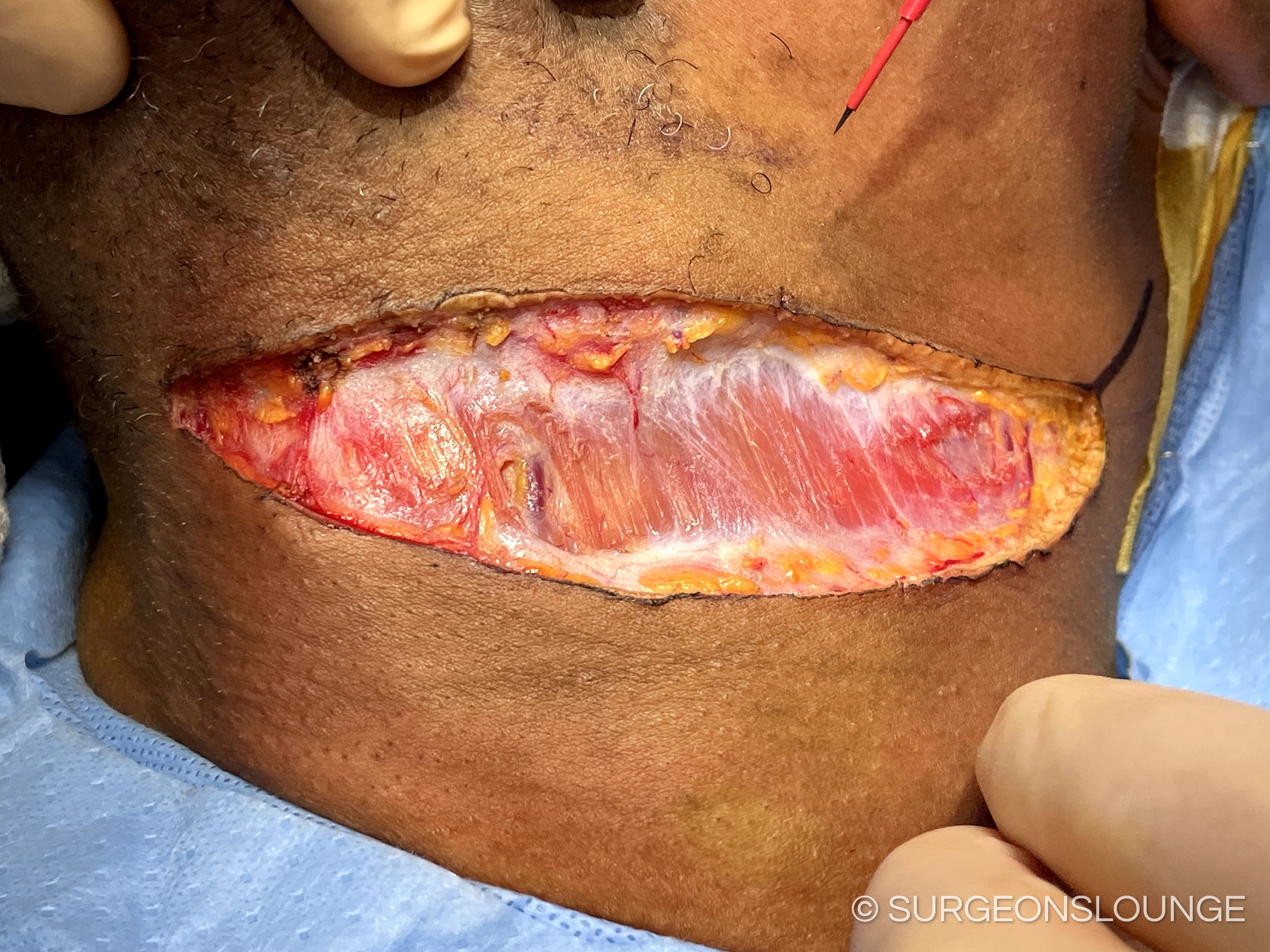 A close up of a woundDescription automatically generated