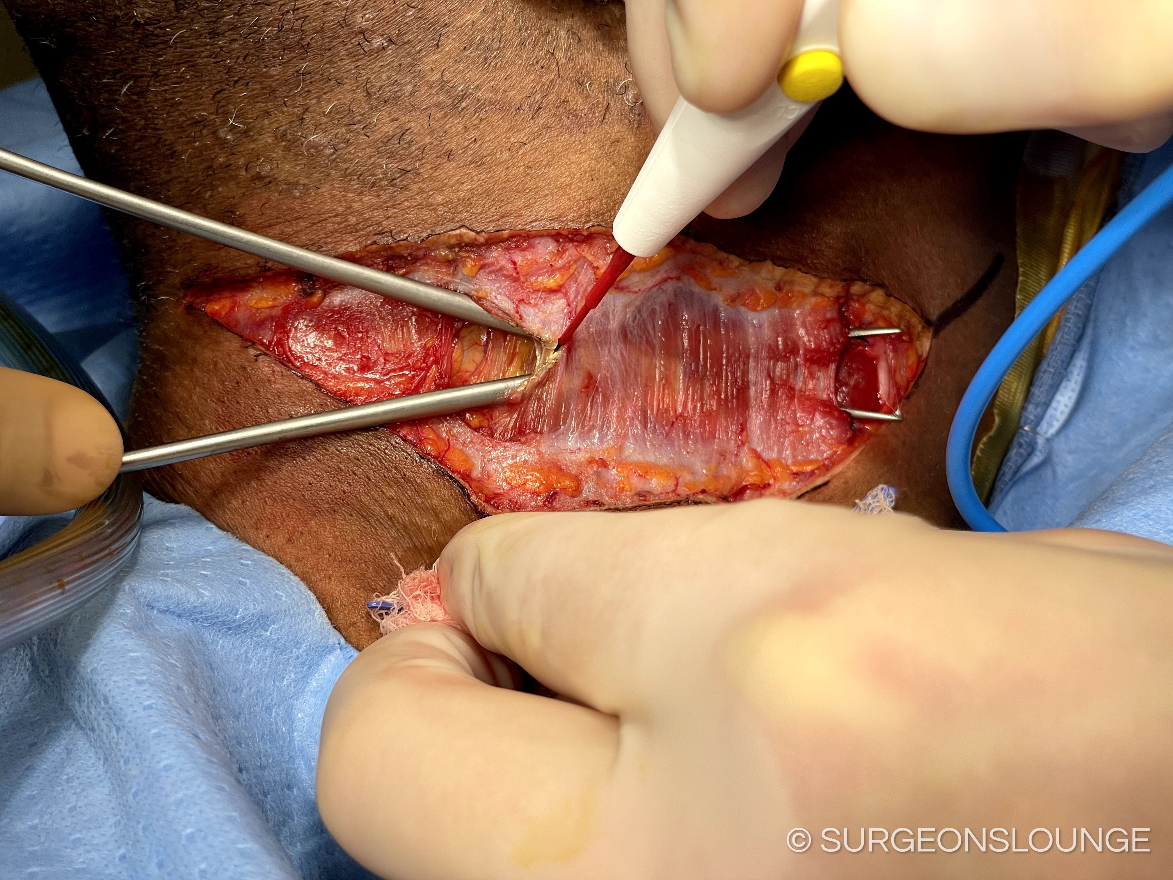 A person performing surgery on a patientDescription automatically generated