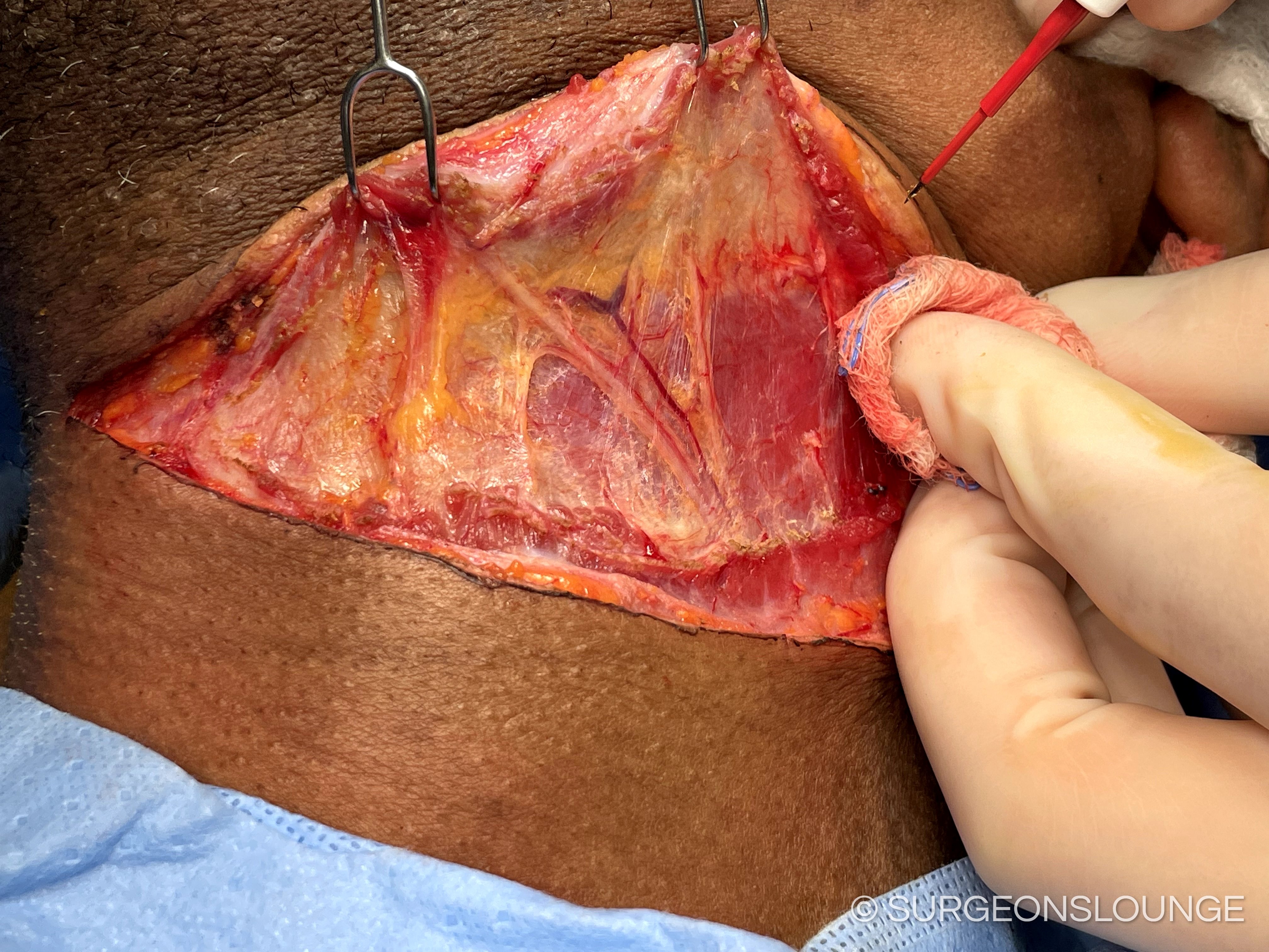 A person performing surgery on a person's chestDescription automatically generated