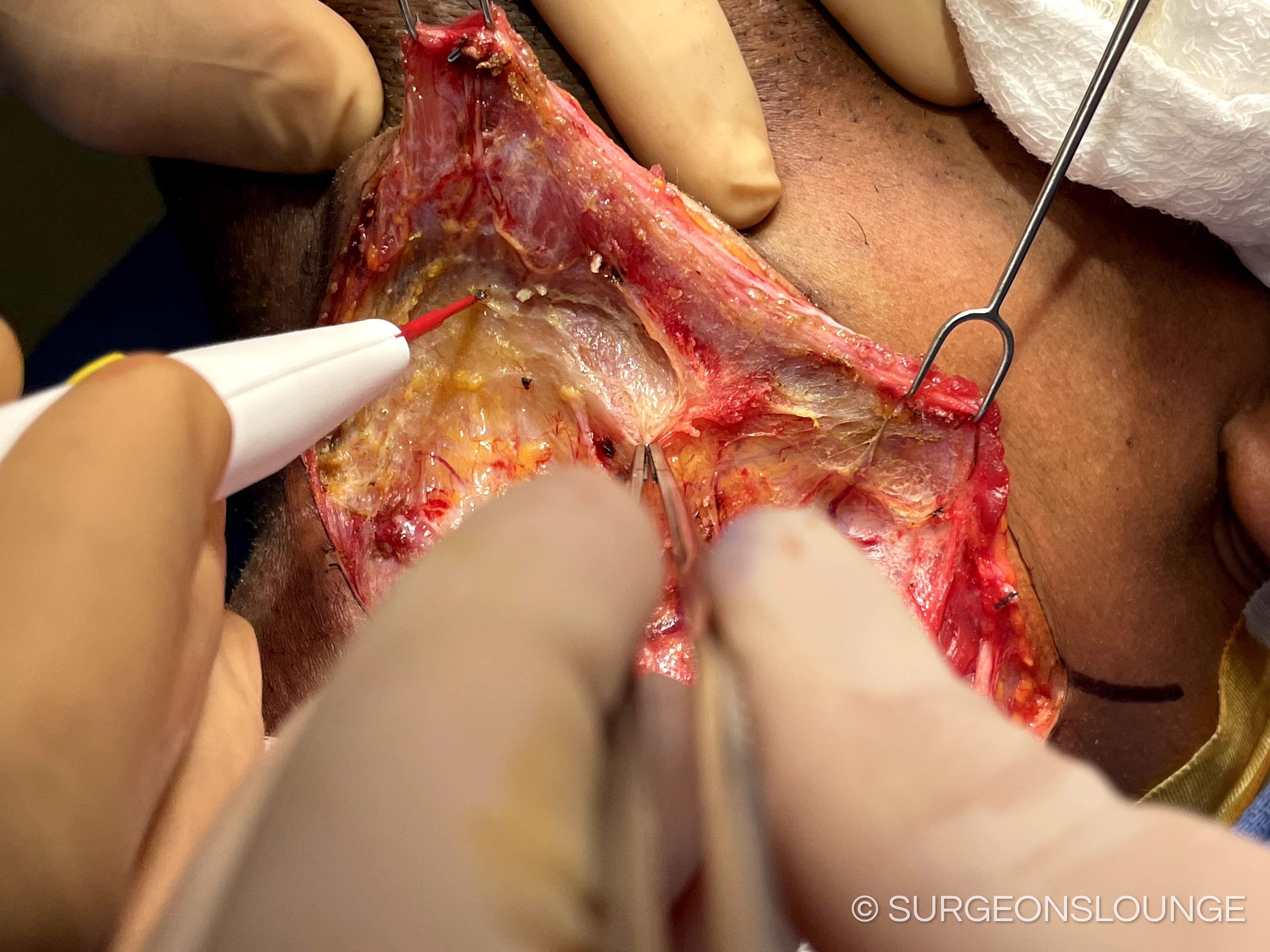 A person performing surgery on a person's bodyDescription automatically generated