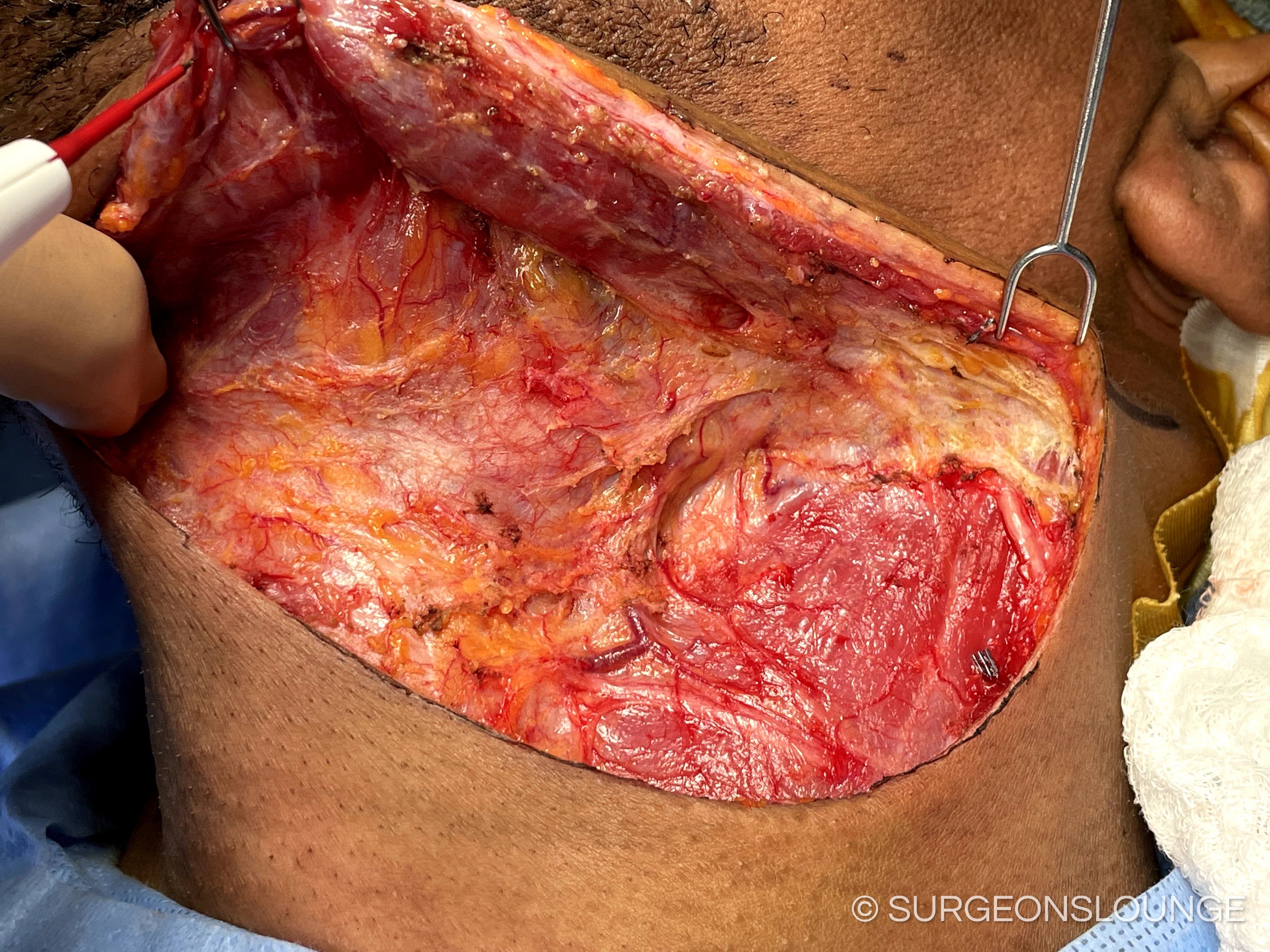 A person with a wound on his stomachDescription automatically generated