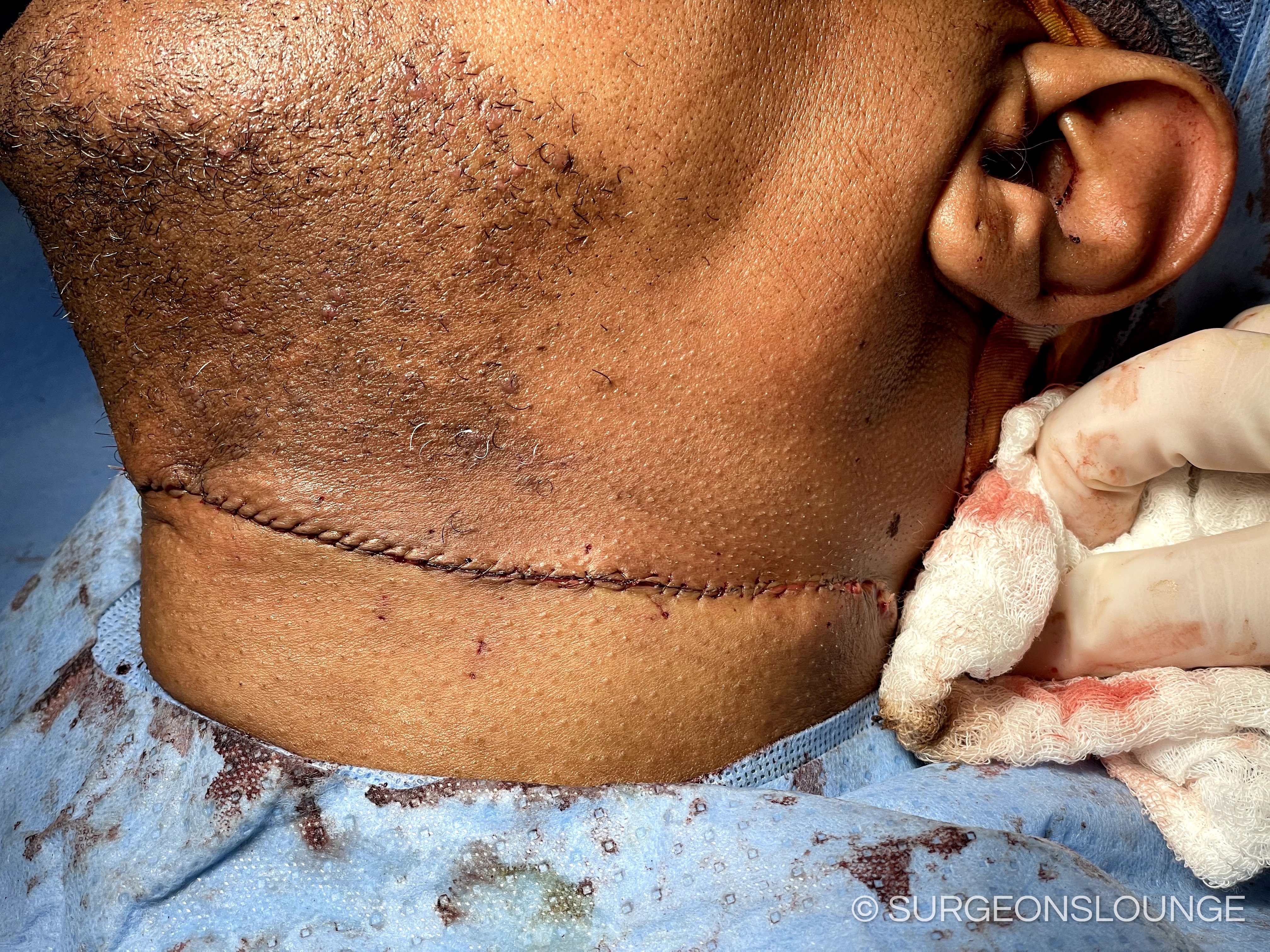 A close up of a scar on a person's neckDescription automatically generated