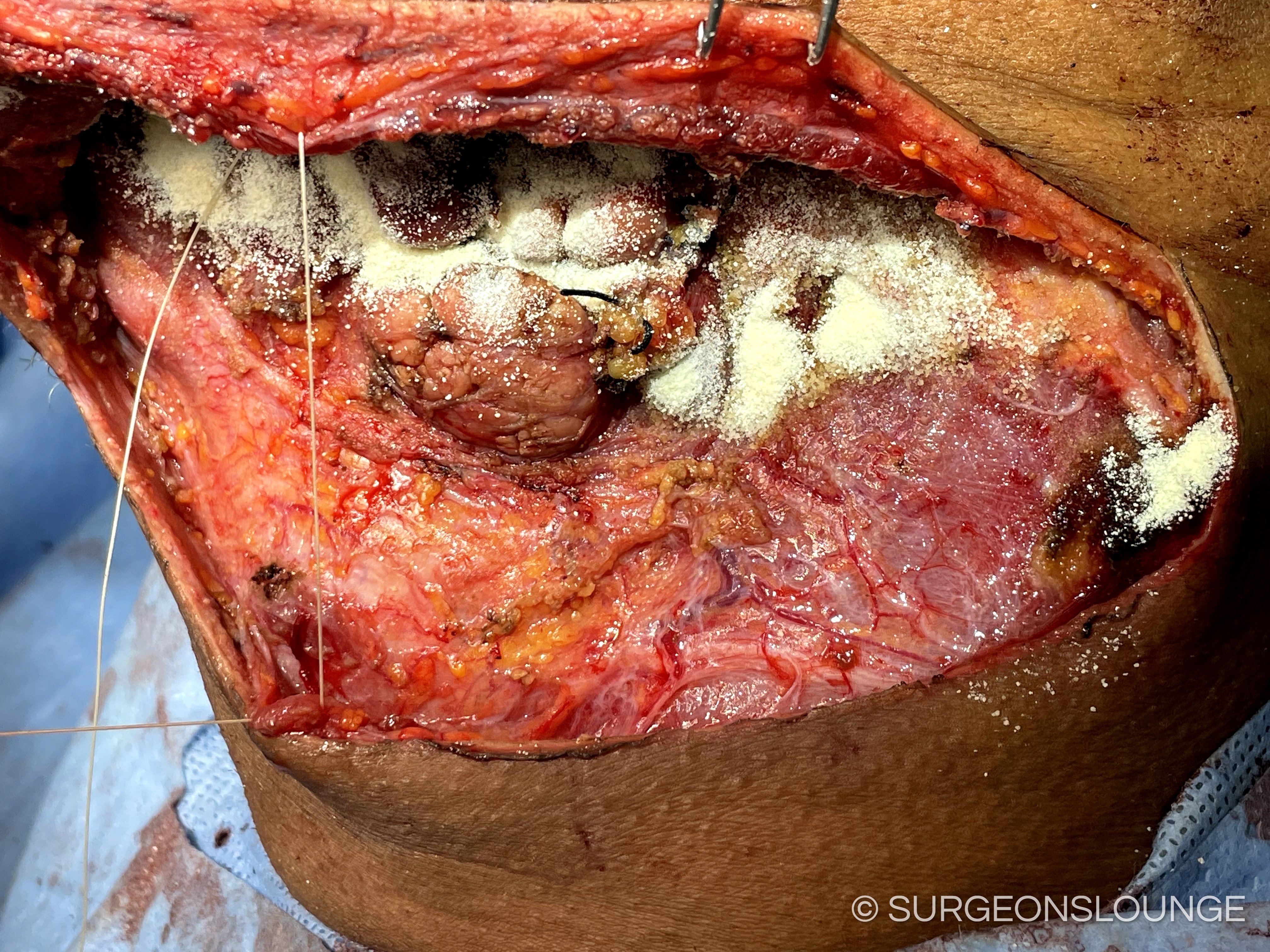 A close up of a woundDescription automatically generated