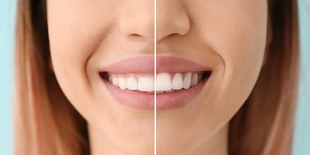 Close-up of a woman's smile showing a before and after comparison of gum contouring.