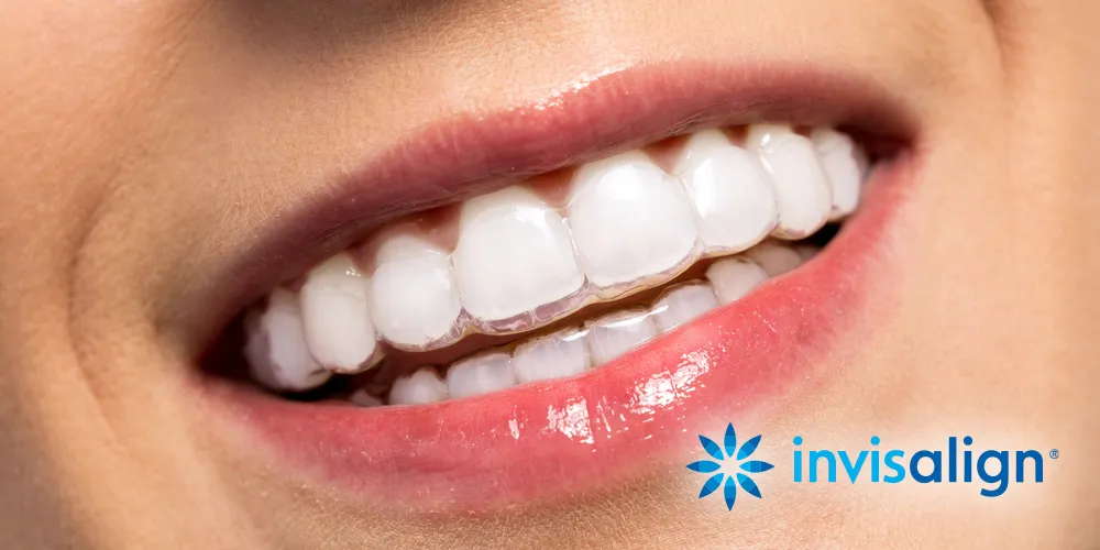 Close-up of a smiling mouth wearing clear Invisalign aligners on teeth.