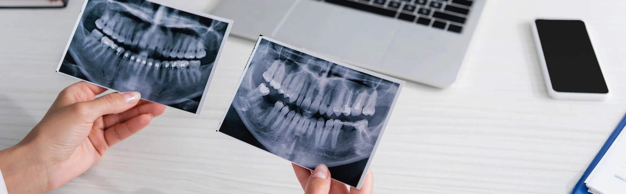 Can You Benefit from Dental Implants in Sumter SC