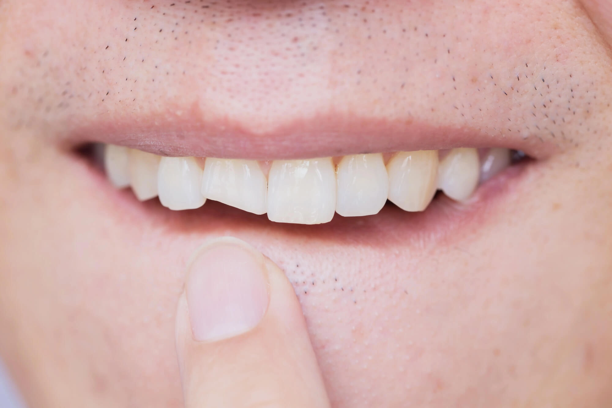 Cracked tooth needs dental crown randolph nj