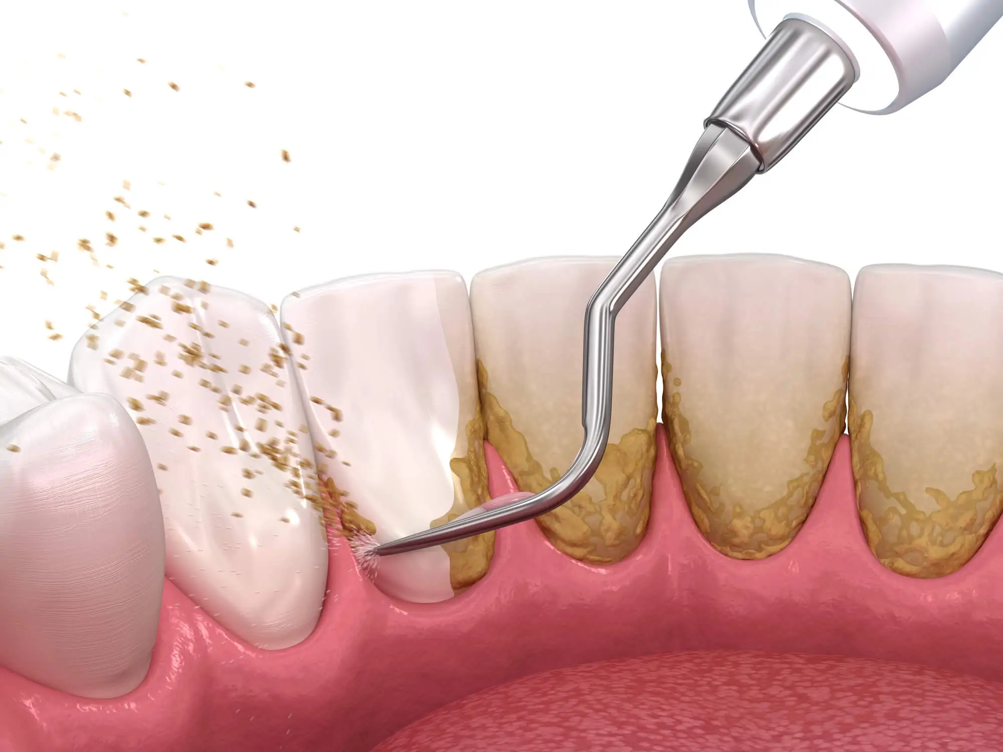 Illustration of Periodontal Scalling and Root Planning