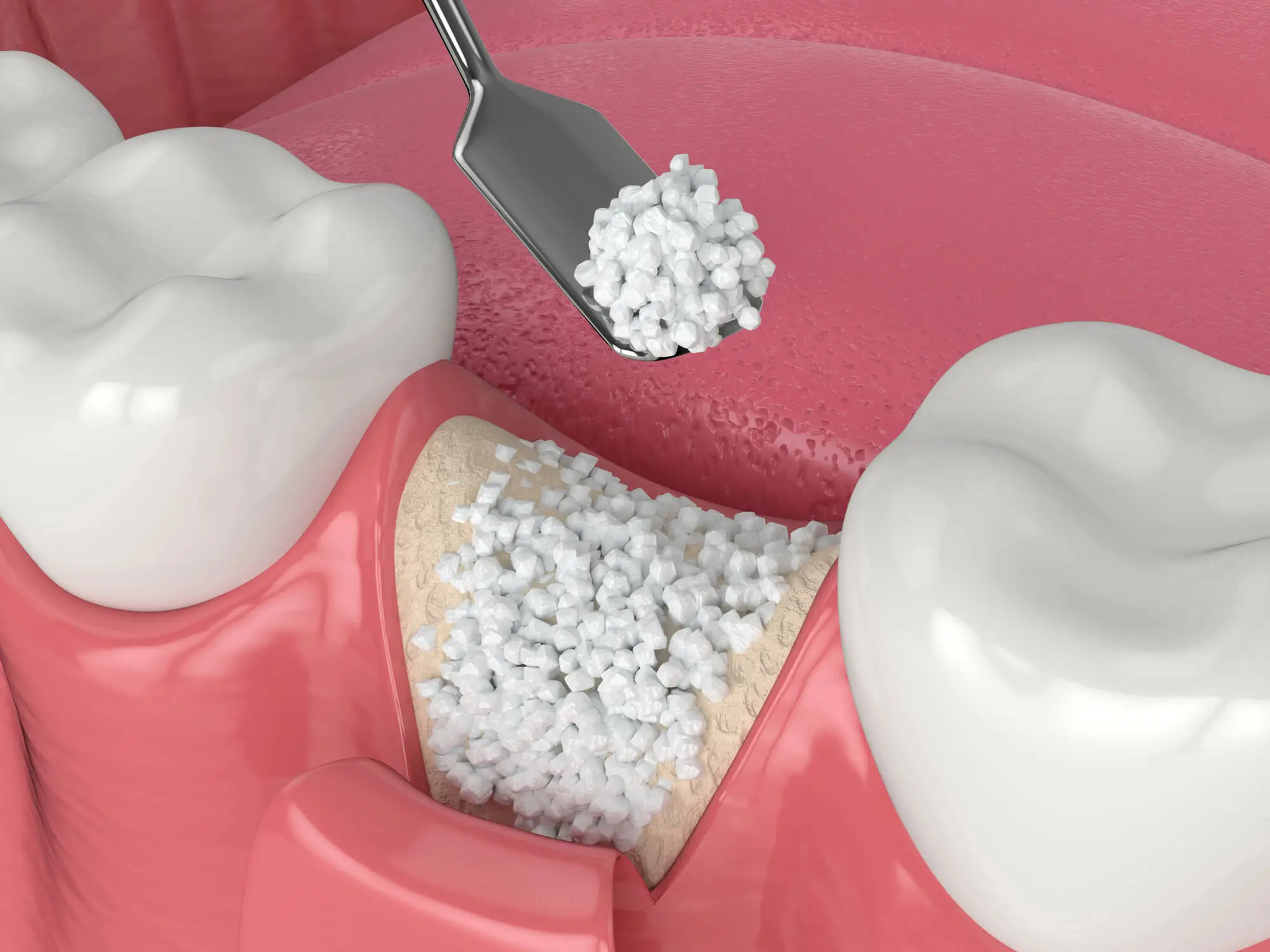 Illustration of Bone Grafting for Dental Implants