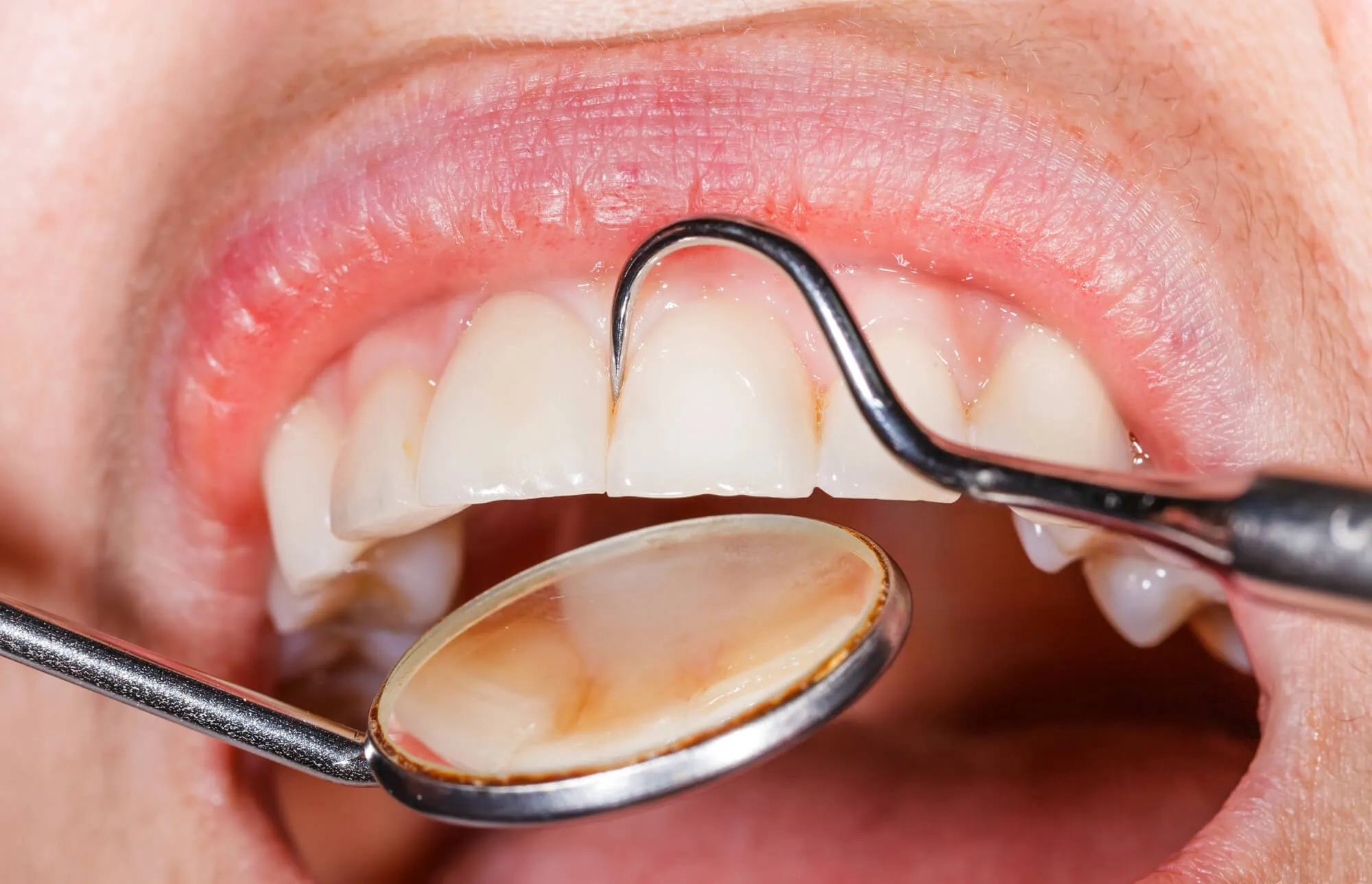 Periodontal Maintenance for Long-Term Gum Health 