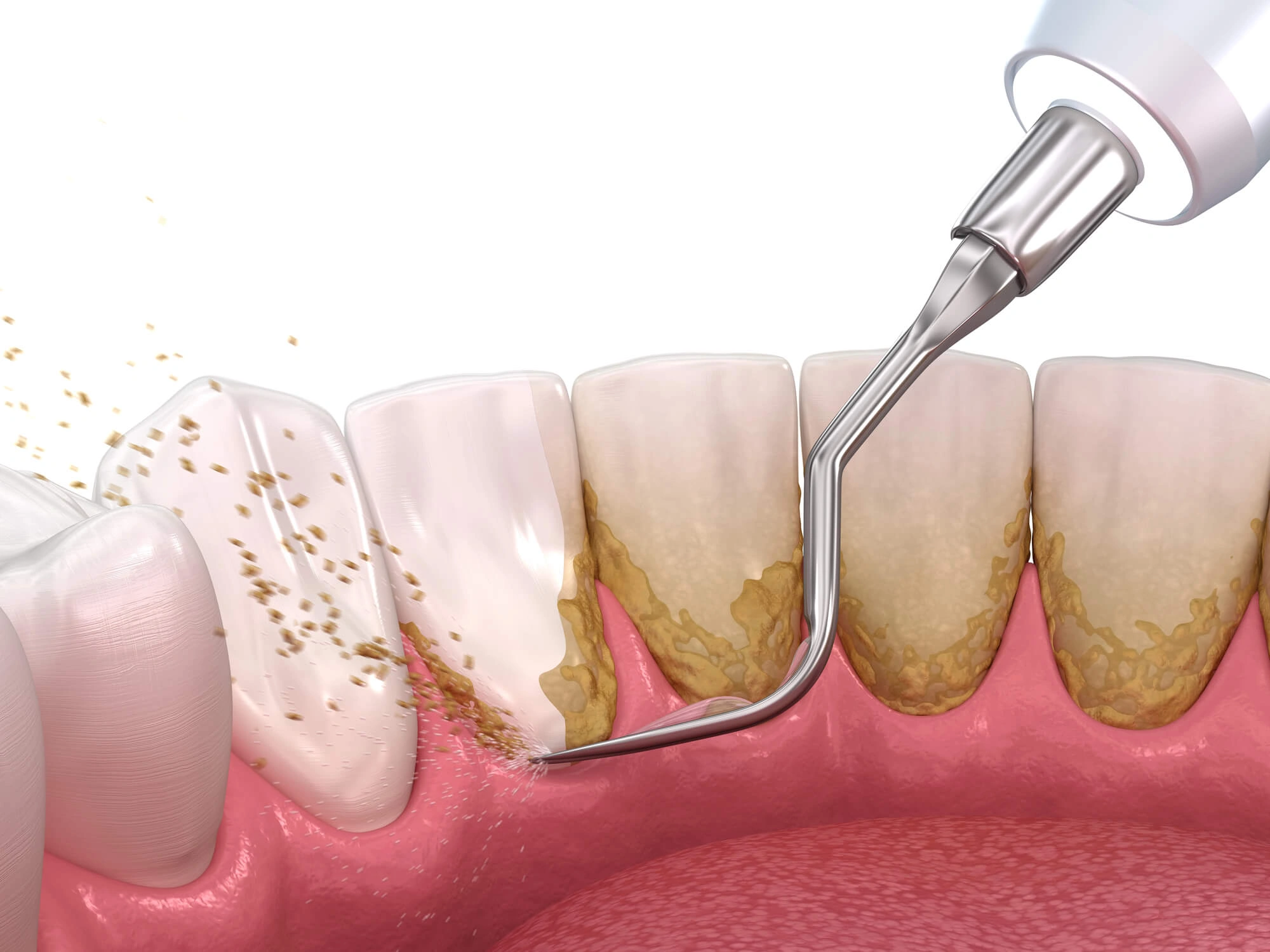 periodontal treatment northport
