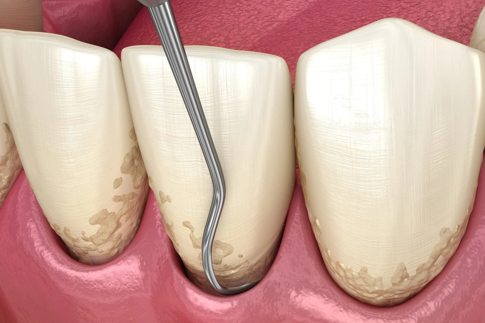 periodontal scaling and root planning