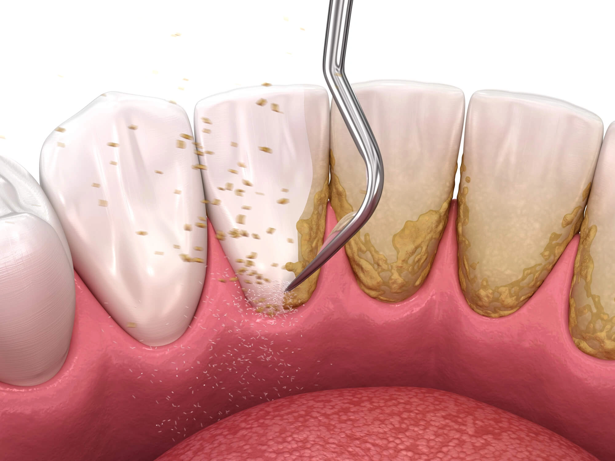 Illustration of periodontal scaling and root planning
