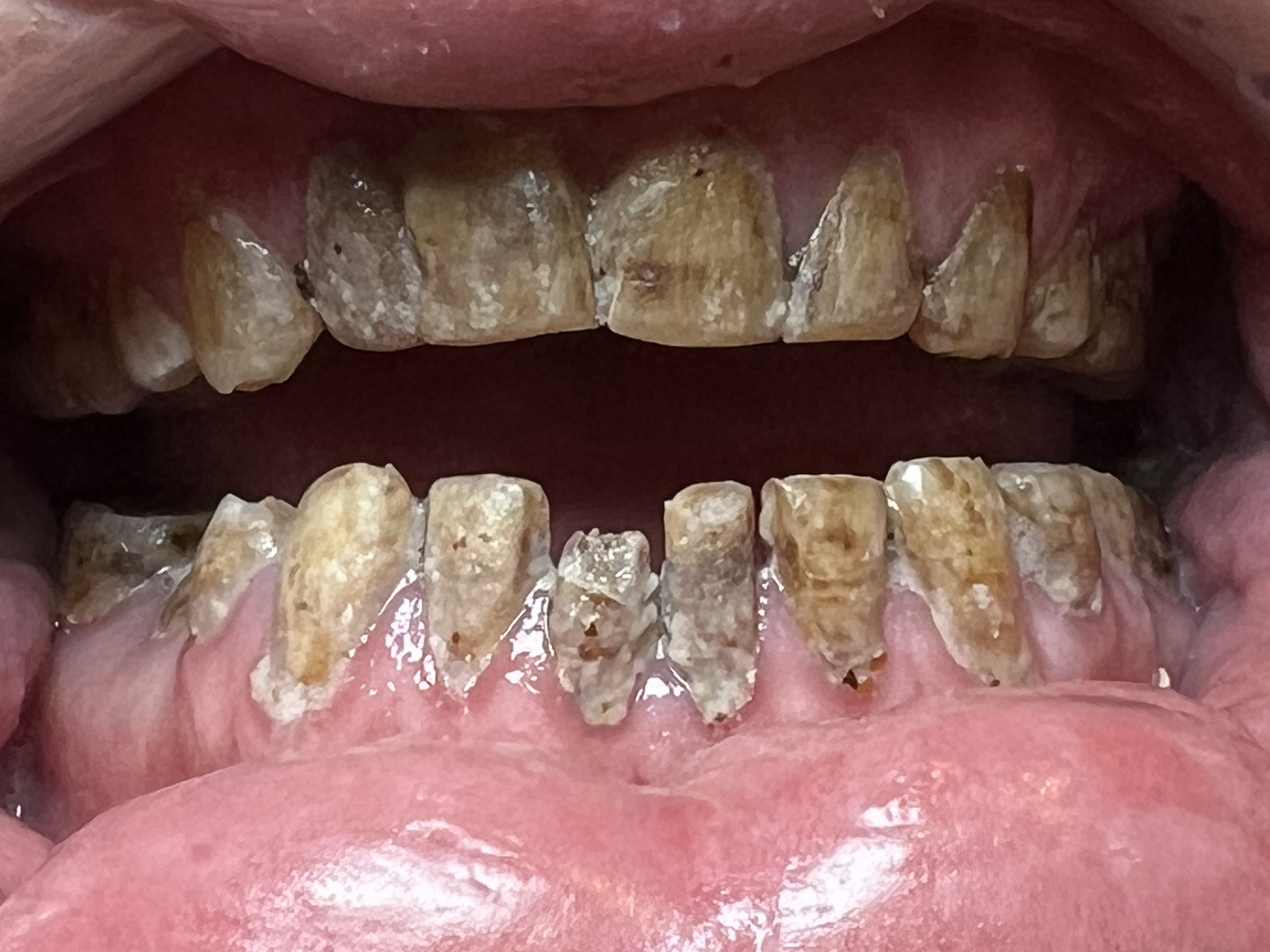 Patient's teeth before treatment, showing severe decay and discoloration