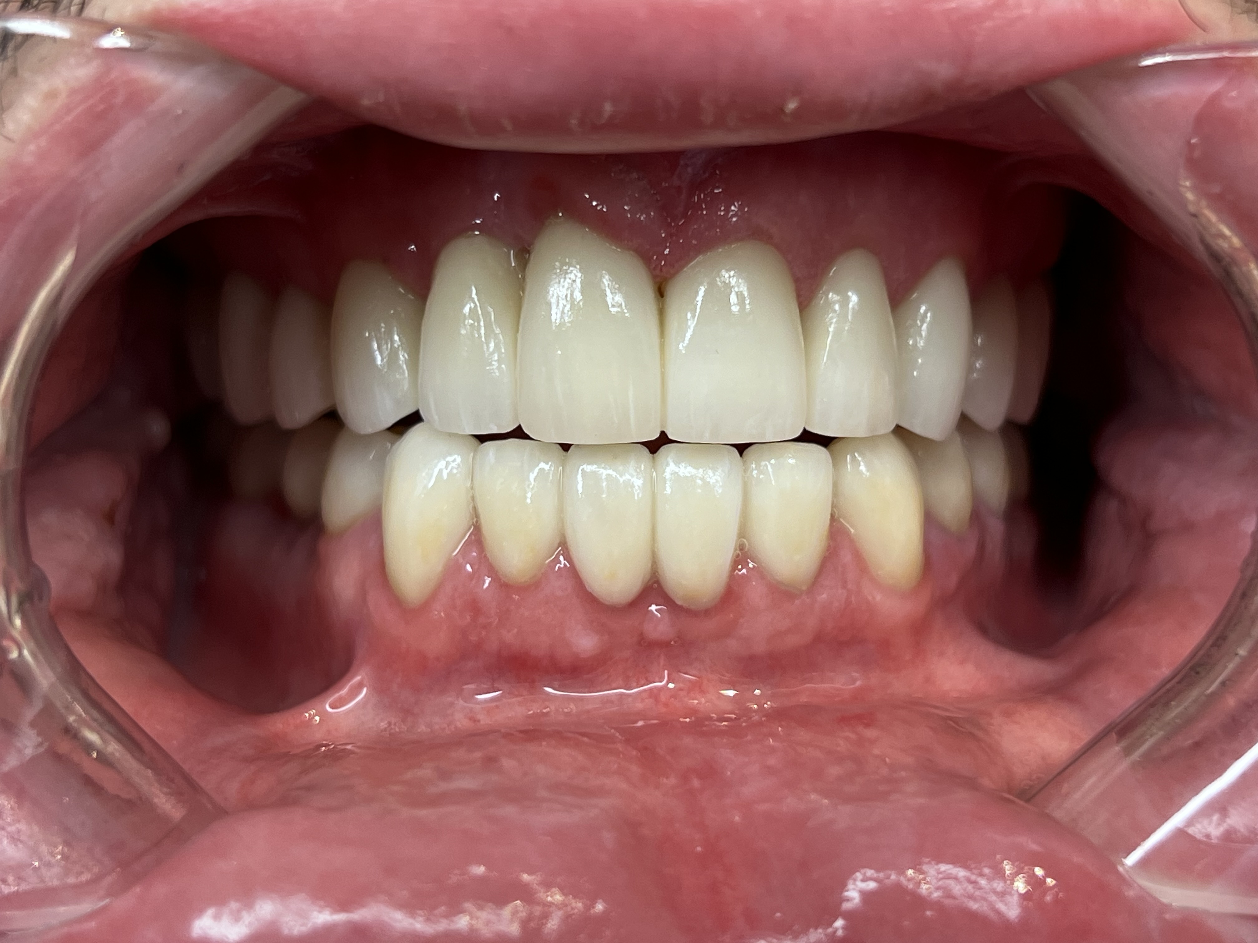 Same patient after full-mouth rehabilitation with new restorations