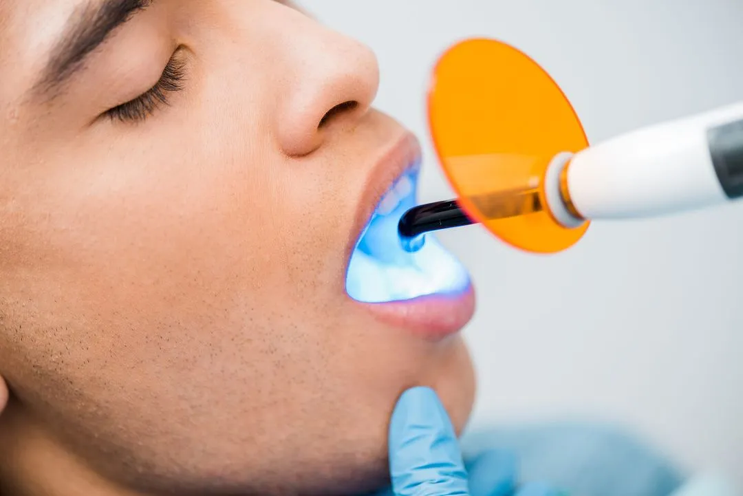 Close-up of a patient receiving a dental curing light procedure, used to harden composite materials during restorative treatments.