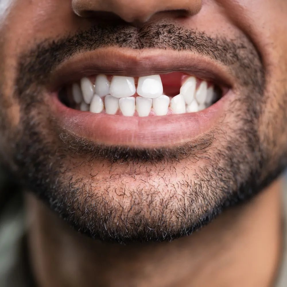 Close-up of a man's mouth showing a missing front tooth, revealing a gap in his smile and exposed gum tissue.