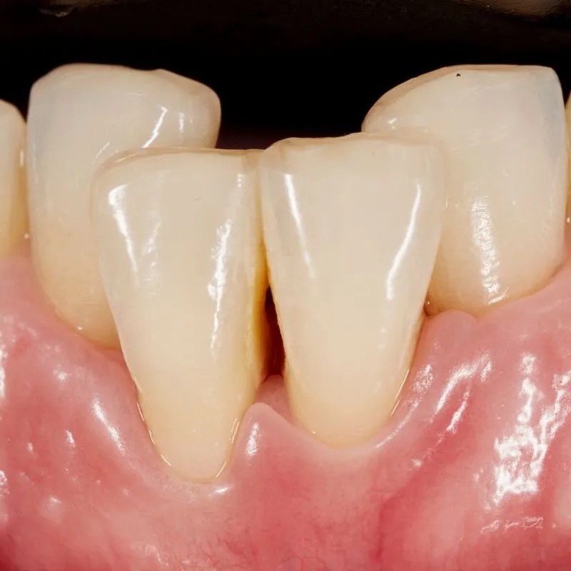 Close-up image of lower front teeth showing gum recession and exposed tooth roots, indicative of periodontal disease.