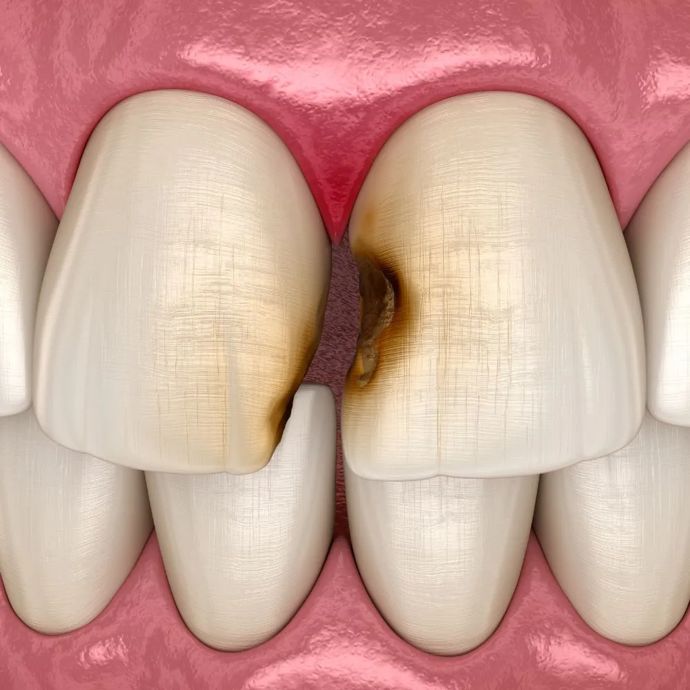 Illustration of upper front teeth showing advanced tooth decay between two incisors, with visible brown cavities and enamel damage.