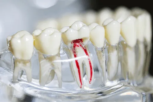A clear dental model showing teeth with one molar cut open to display root canal anatomy, including red-colored canals for educational use.