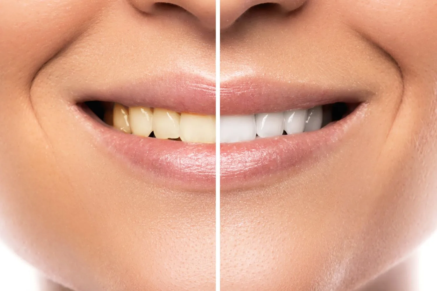 Side-by-side comparison of a person’s smile showing yellow-stained teeth on the left and bright white teeth on the right after whitening.