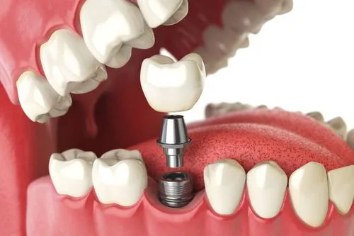 A close-up 3D model showing the step-by-step placement of a dental implant with abutment and crown in the lower jaw.