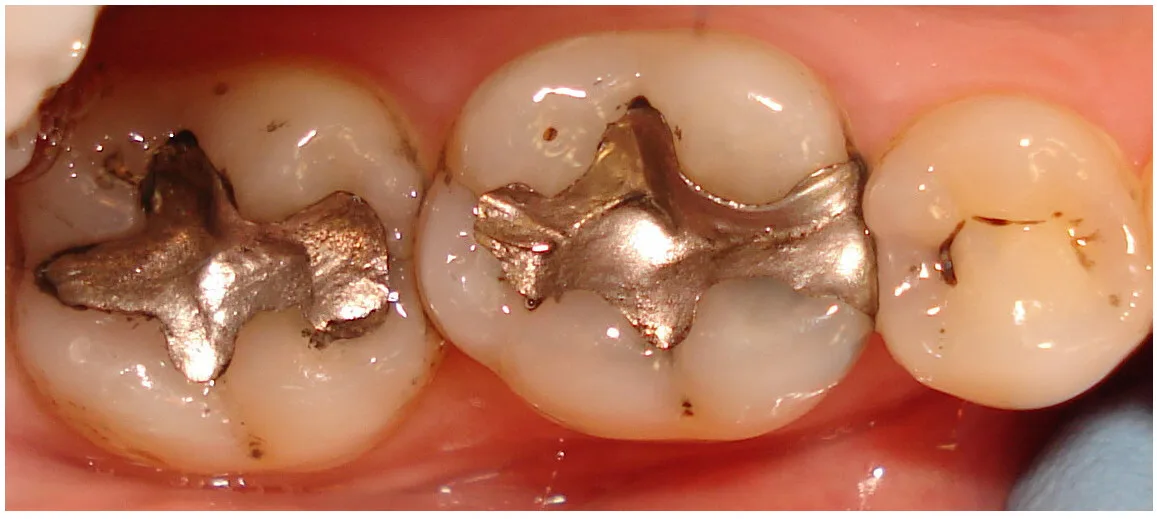 Close-up of three molar teeth, two with silver dental fillings and one natural tooth with minor discoloration.