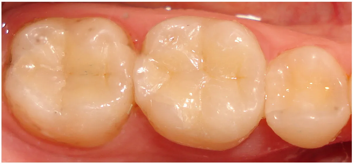 Close-up of three natural molar teeth with healthy gums.