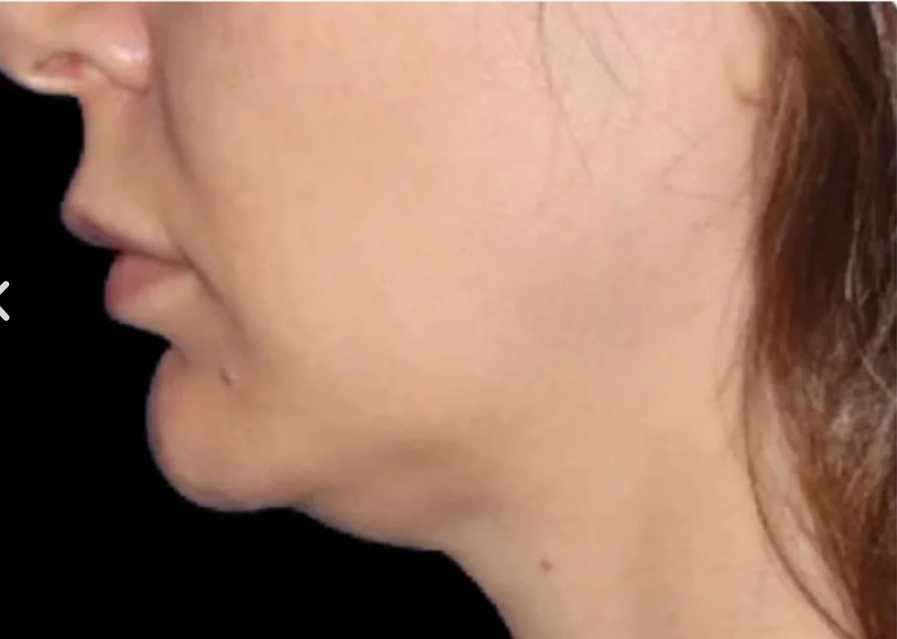 Close-up side profile of a person's lower face, jawline, and neck with light skin and brown hair against a black background.