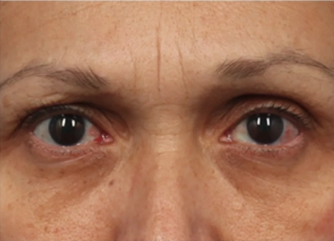 Close-up of human eyes with visible redness in the left eye and natural skin texture around them.