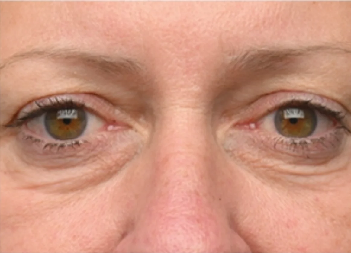 Close-up of a person's face focusing on their brown eyes and surrounding skin details.