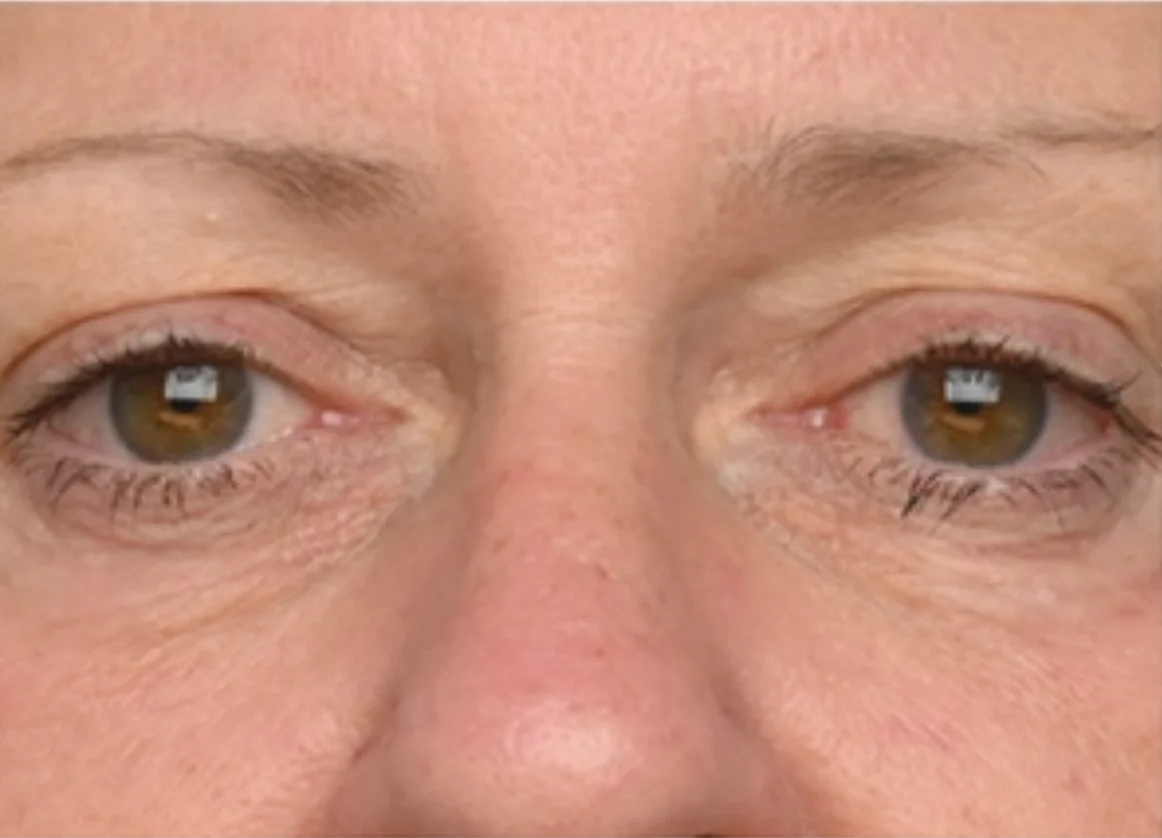 Close-up of a person's face focused on brown eyes and the skin around them.