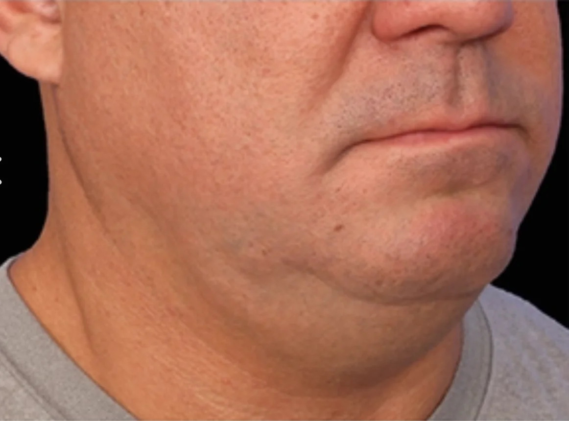 Close-up of the lower face and neck of a middle-aged man with slight stubble and neutral expression.
