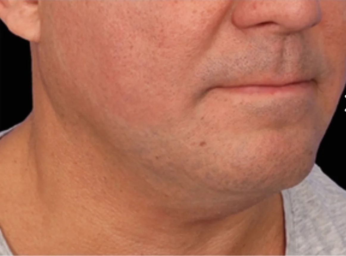 Close-up of the lower face and neck of a middle-aged man with lightly tanned skin and slight stubble.