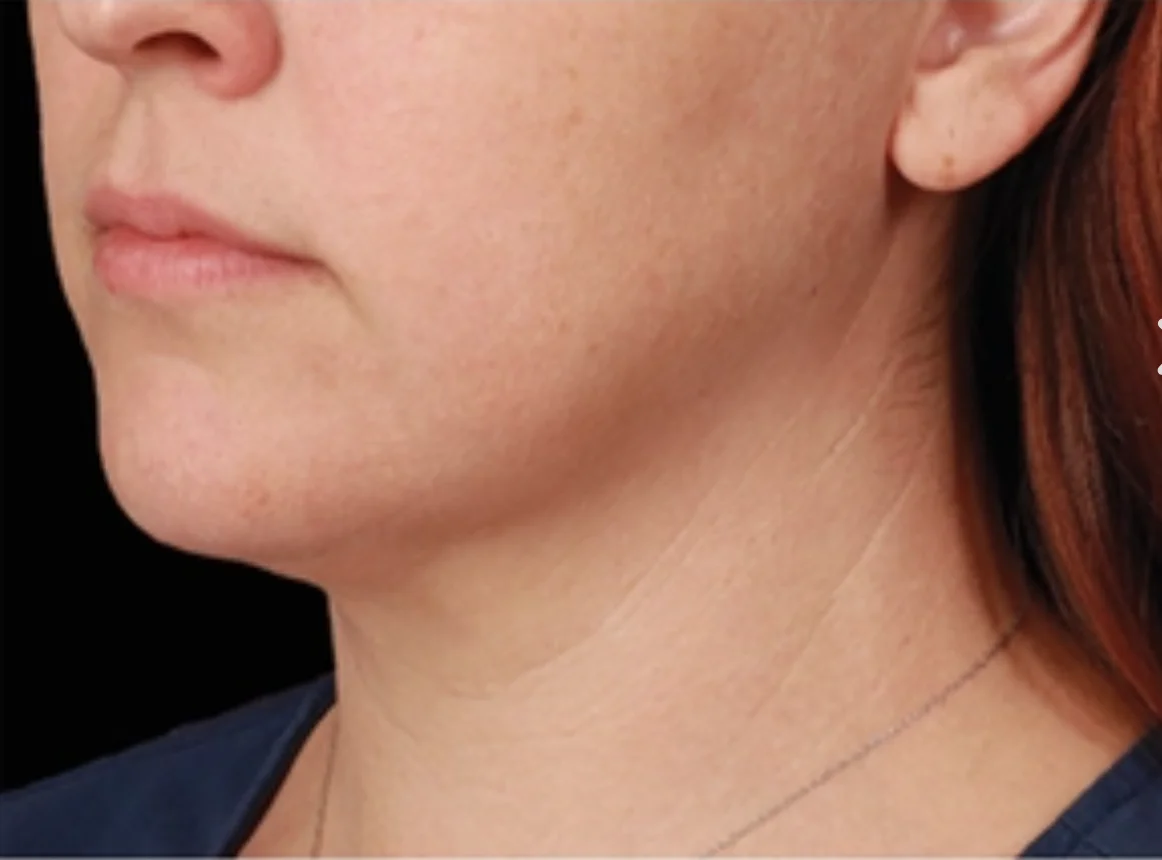 Close-up of the lower face, jawline, and neck of a person with fair skin and straight red hair against a black background.