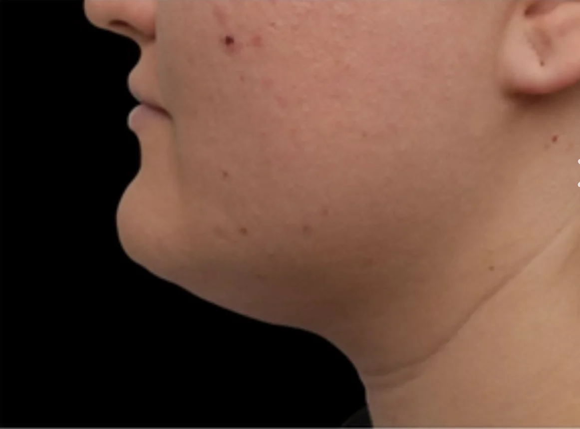 Close-up side view of a person's lower face and neck with mild acne and skin blemishes.
