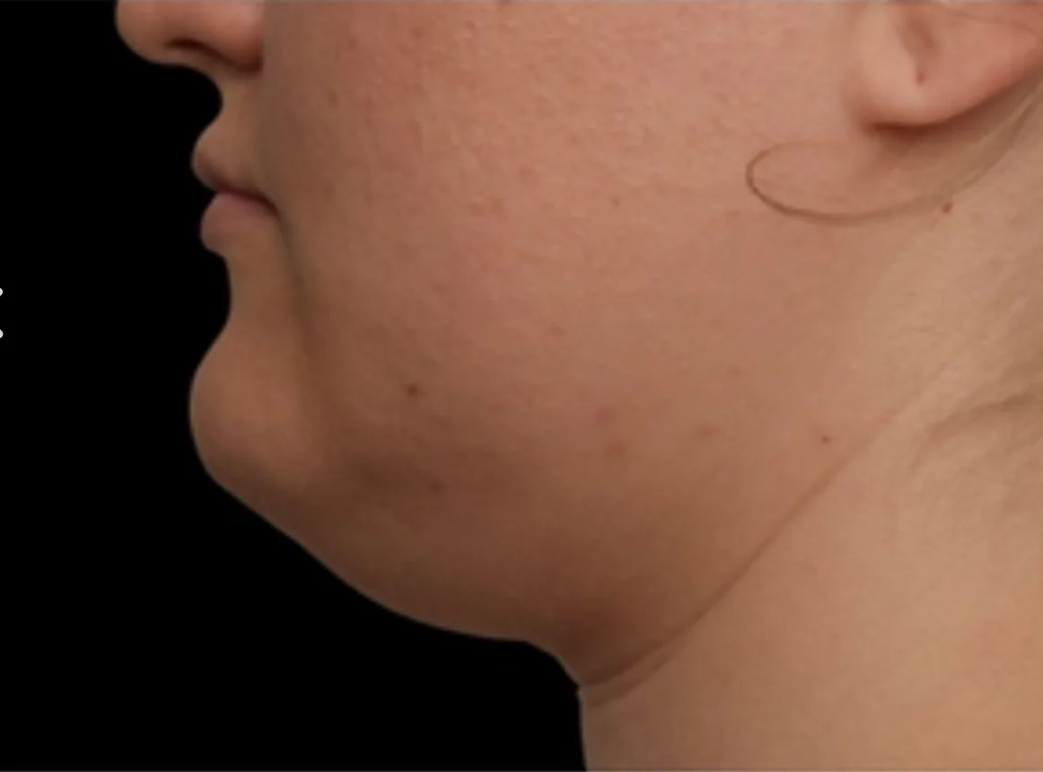 Close-up side profile of a person's lower face and neck, showing skin texture and a slight double chin against a black background.