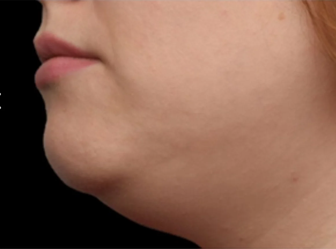 Close-up side view of a person’s lower face showing a slightly protruding chin and lips against a black background.