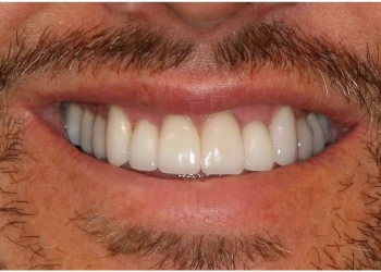 Close-up of a person smiling showing clean and well-aligned upper teeth with a mustache and light facial hair.