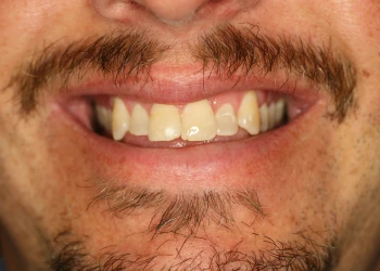 Close-up of a smiling mouth showing teeth with a mustache and goatee.