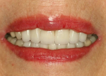 Close-up of a smiling mouth showing white, well-aligned teeth with red lipstick on lips.